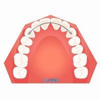 リテーナー（固定）.jpg