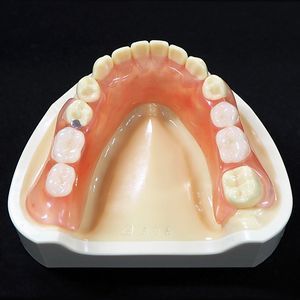 ノンクラスプデンチャー 吹田市の歯医者 吹田駅前歯科